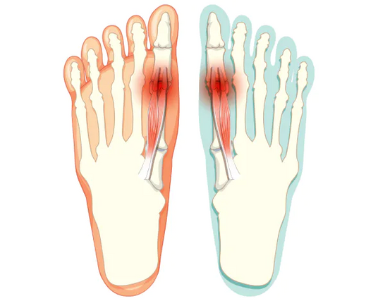 Consistent toe freedom following the BÄR principle