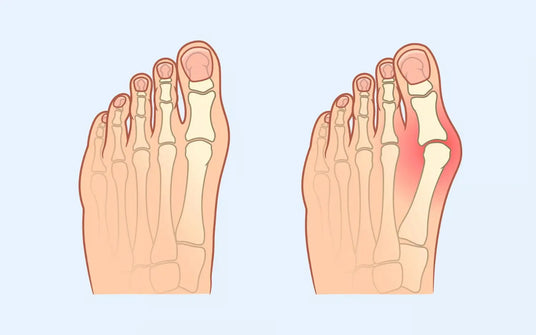 Stylish shoes for hallux valgus and demanding feet
