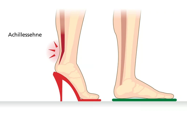 Graphic showing the Achilles tendon under stress from wearing high heels and flat shoes.