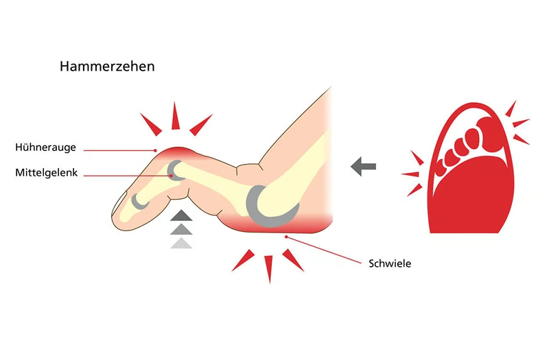 Illustration of a hammertoe showing a corn, middle joint, and callus